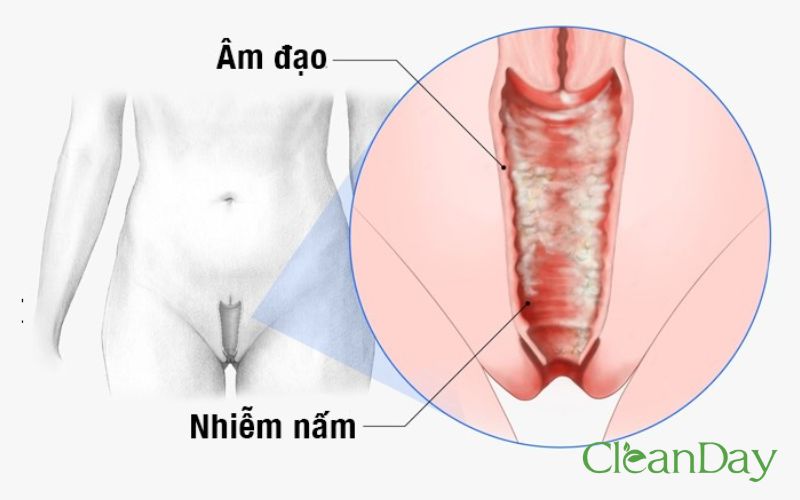 Triệu chứng của viêm âm đạo do nhiễm nấm candida