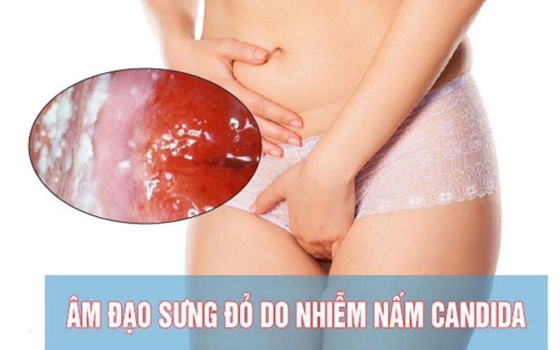 Candida hình ảnh bị nấm vùng kín sưng âm đạo 