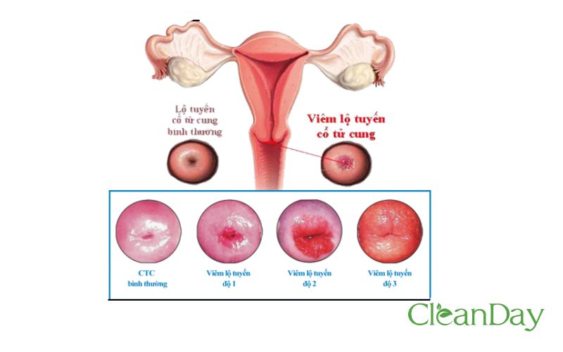 Hình ảnh các cấp độ viêm lộ tuyến cổ tử cung